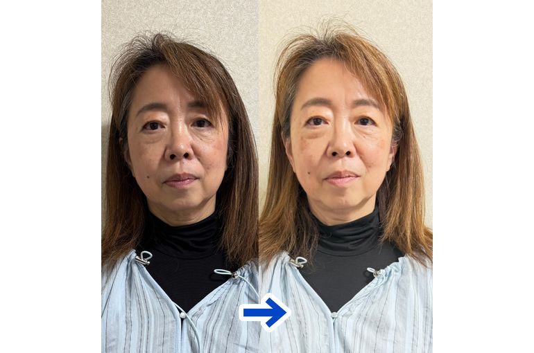ビフォアフ